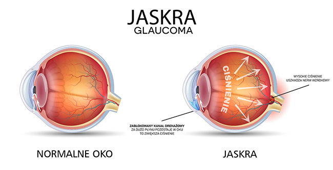 Jaskra - uszkodzenie nerwu wzrokowego