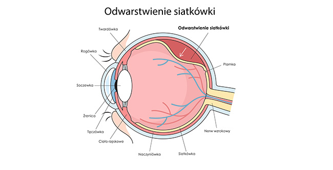 Odwarstwienie siatkówki