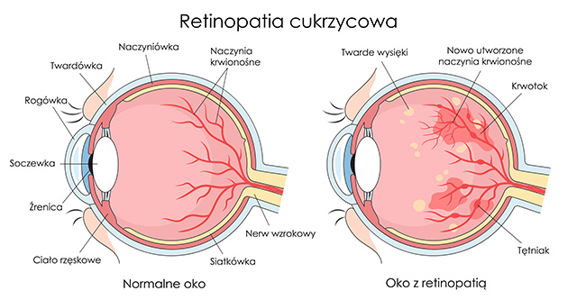 Retinopatia cukrzycowa - zmiany na siatkówce