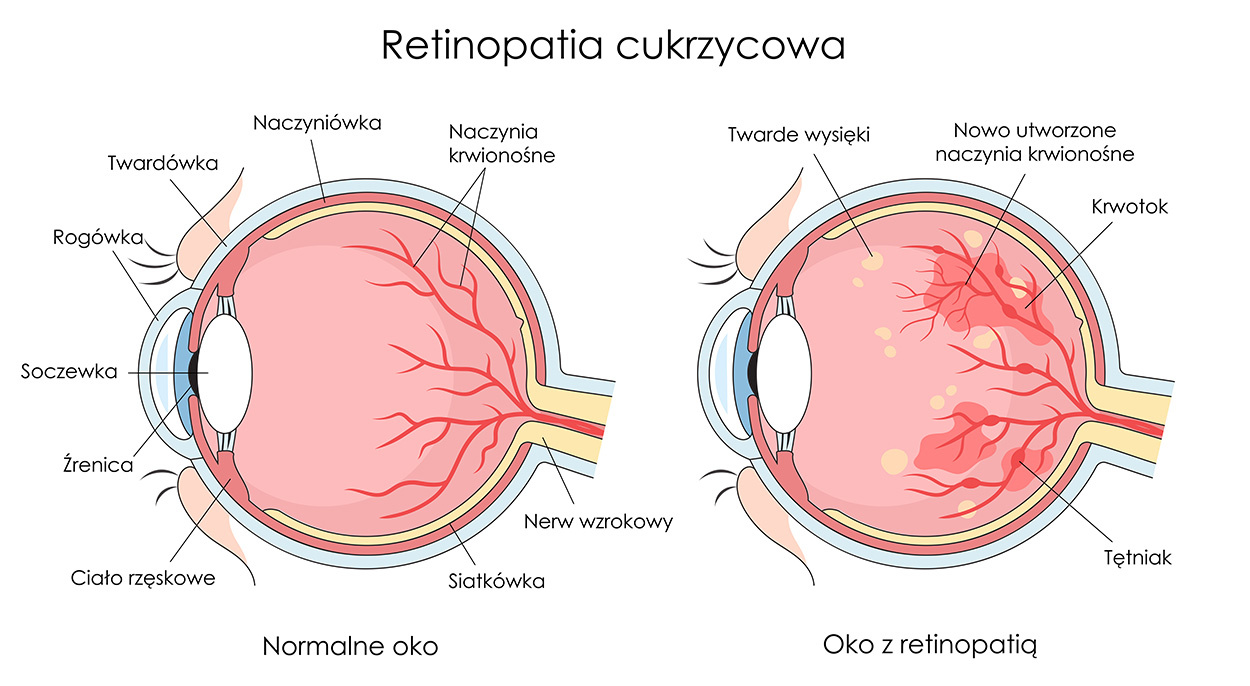 zdrowe oko i retinopatia cukrzycowa