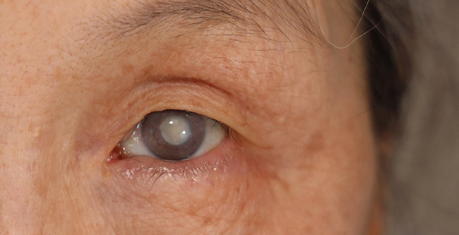 Zaćma - zmętnienie soczewki oka