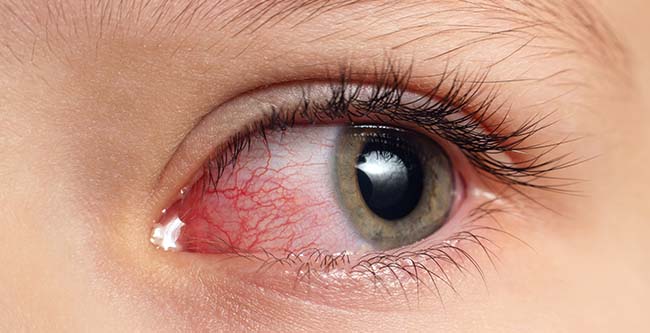 Zapalenie spojówek - zaczerwienione oko