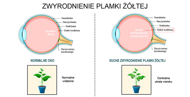 Schemat zwyrodnienia plamki żółtej