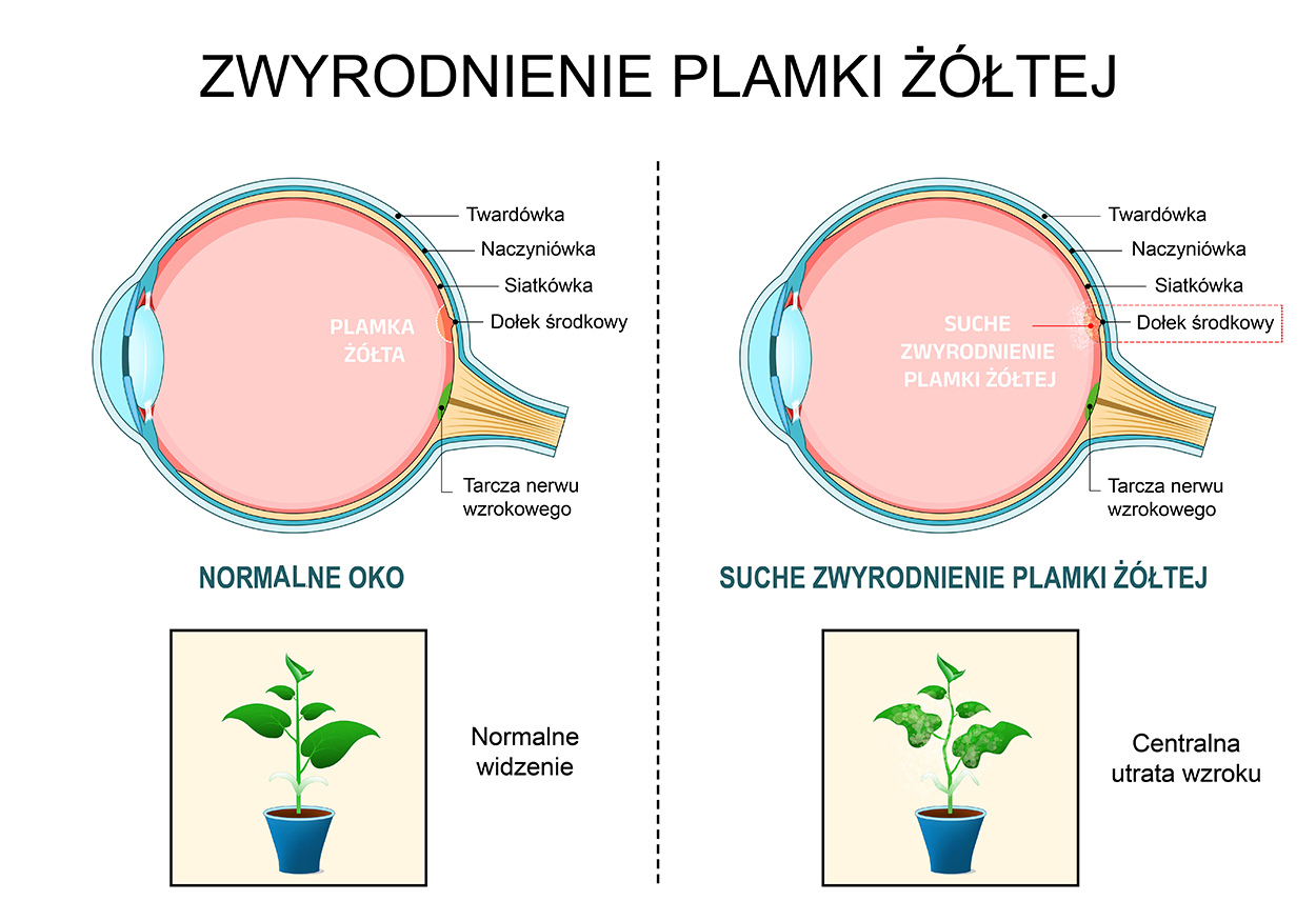 zwyrodnienie plamki żółtej